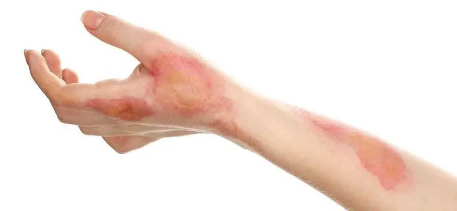 Burn cropped