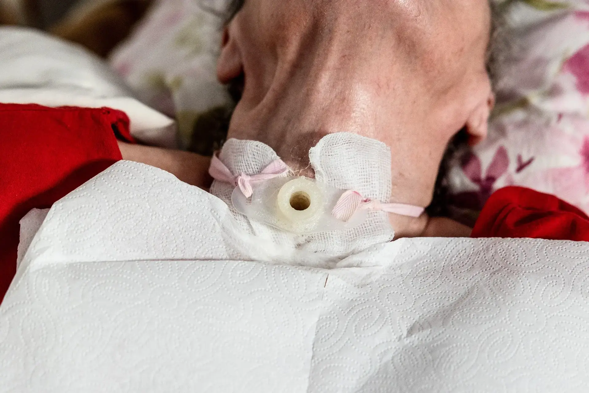 Tracheostomy
